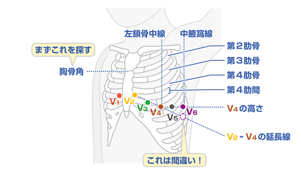 心電図 胸部誘導 電極の付け方のポイント