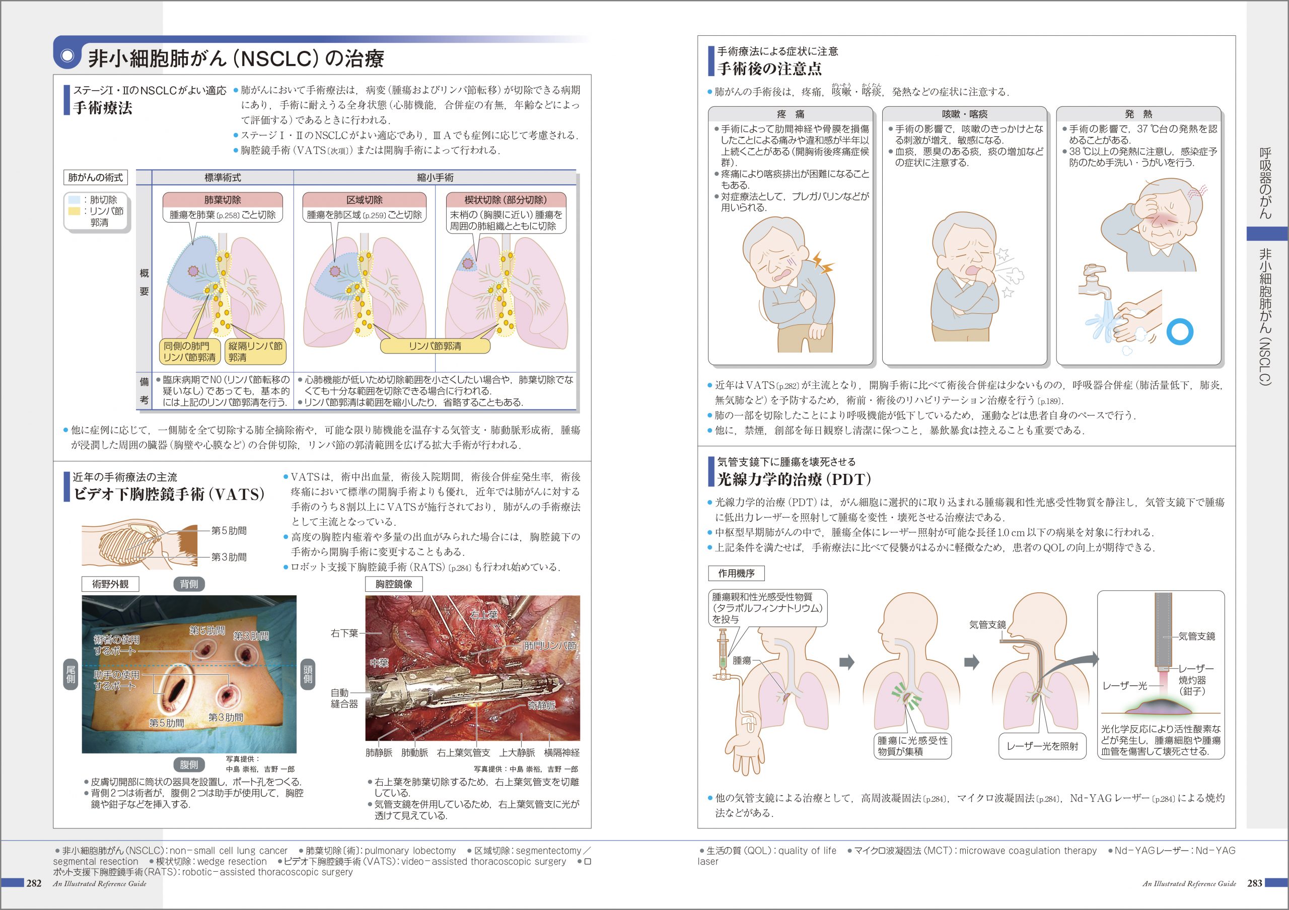 『がんがみえる』 紙面イメージ
VATS 胸腔鏡手術
光線力学的治療