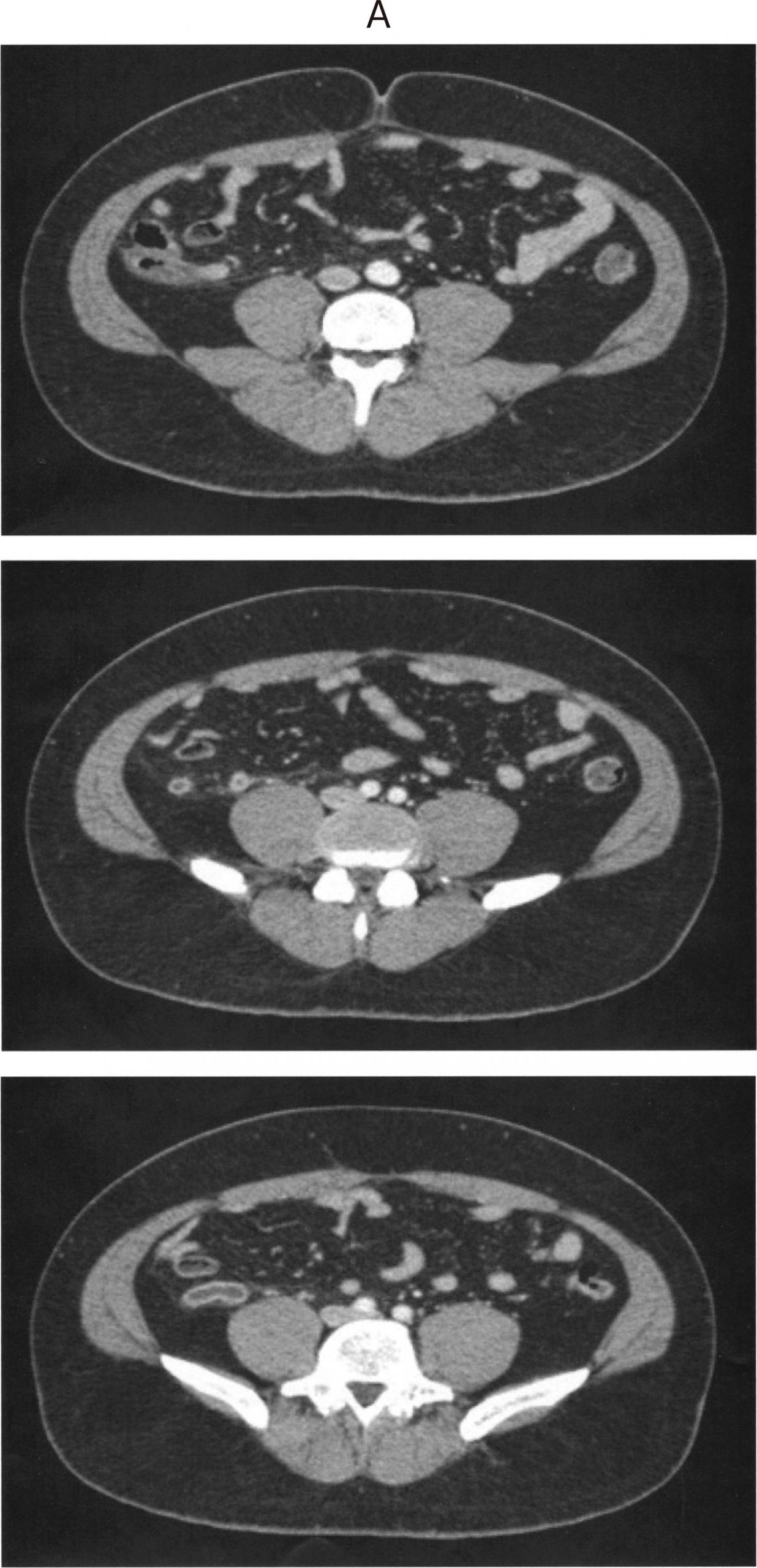 116A74 急性虫垂炎 腹部造影CT 水平断像
