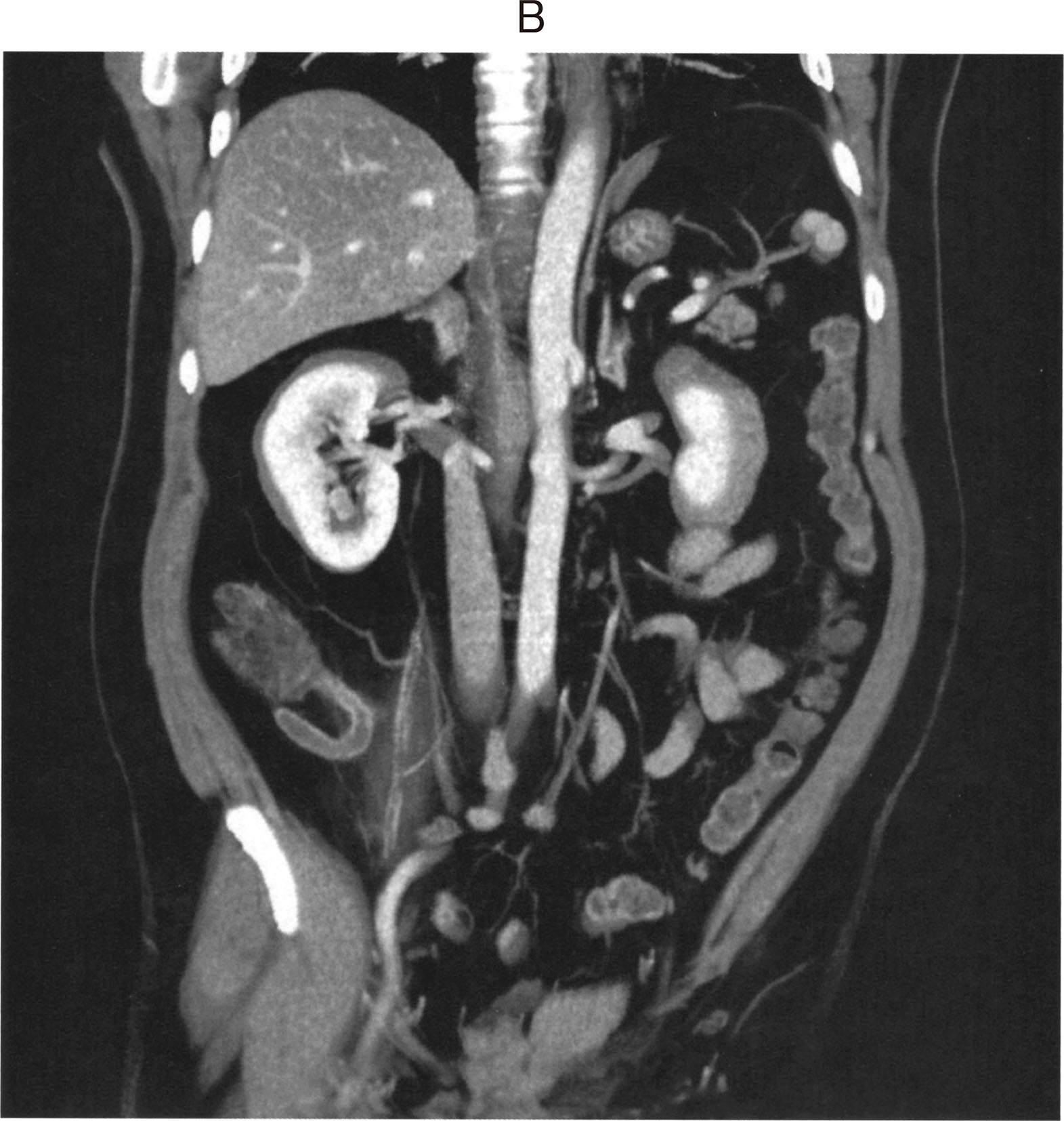 116A74 急性虫垂炎 腹部造影CT 斜冠状断像